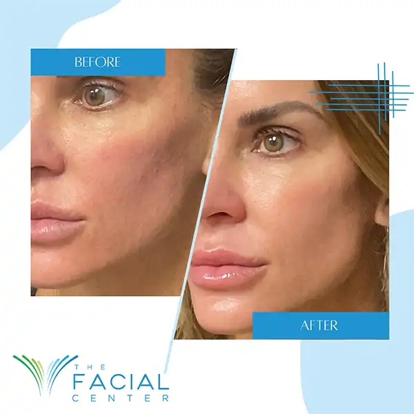 Woman patient's before and after photo from receiving a SKINVIVE™ by JUVÉDERM® treatment at The Facial Center