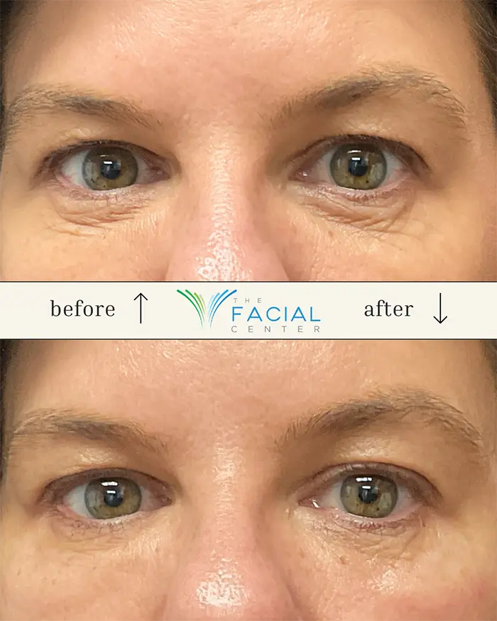 Before and After photo showing difference in undereyes of a patient from The Facial Center in Charleston, WV