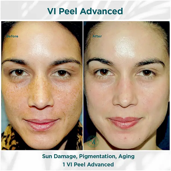 Before and After images of a woman with melasma and fine lines, showing the differerence after just three VI Peel treatments.