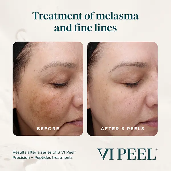 Before and After images of a woman with sun damage, pigmentation and aging, showing the differerence after just one VI Peel treatment.