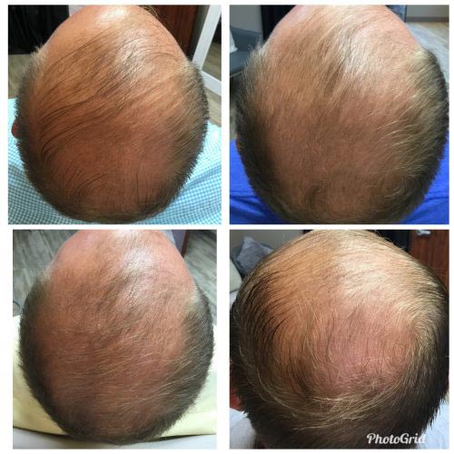 Four progressive pictures of a patient's hair restoration progress at The Facial Center, showing hair regrowth.