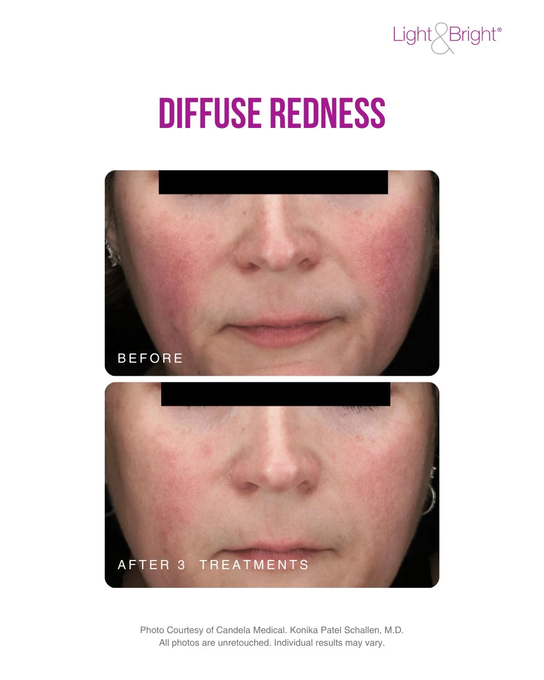 Before and after photos of reduced facial redness following three Nordlys IPL treatments for diffuse redness and rosacea