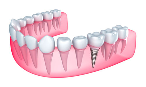 When Should You Expect to Eat Normally Following New Dental Implants?
