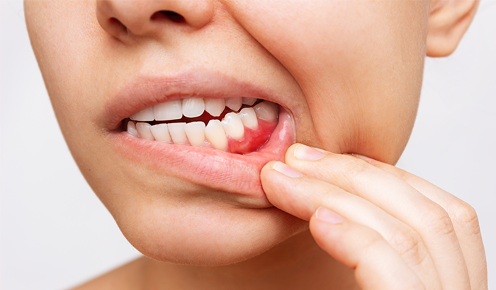 a close up of a mouth with inflamed gums