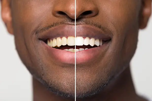 Close up comparison of before and after teeth whitening treatment on a man's smile at The Facial Center in Charleston, WV