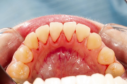 What are the Root Causes of Gum Disease?